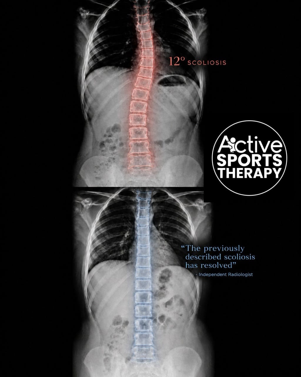 Before and after Active Sports Therapy Scoliosis Care